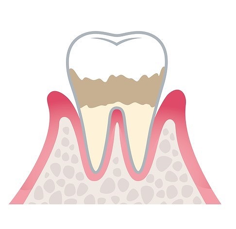 ステージ2：軽度歯周炎