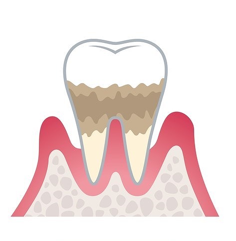 ステージ3：中度歯周炎