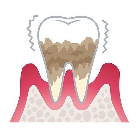 ステージ4：重度歯肉炎