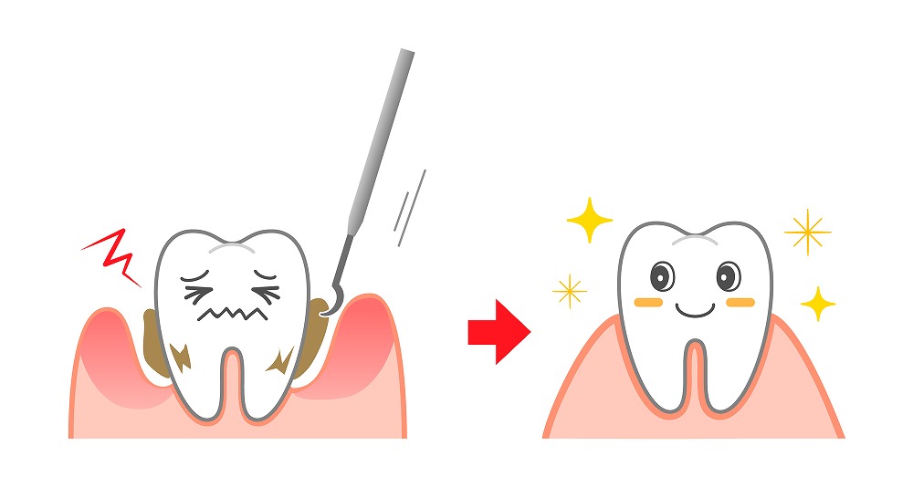 歯垢と歯石の除去