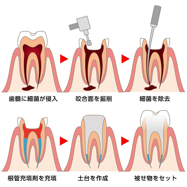 歯の神経の治療(根管治療)